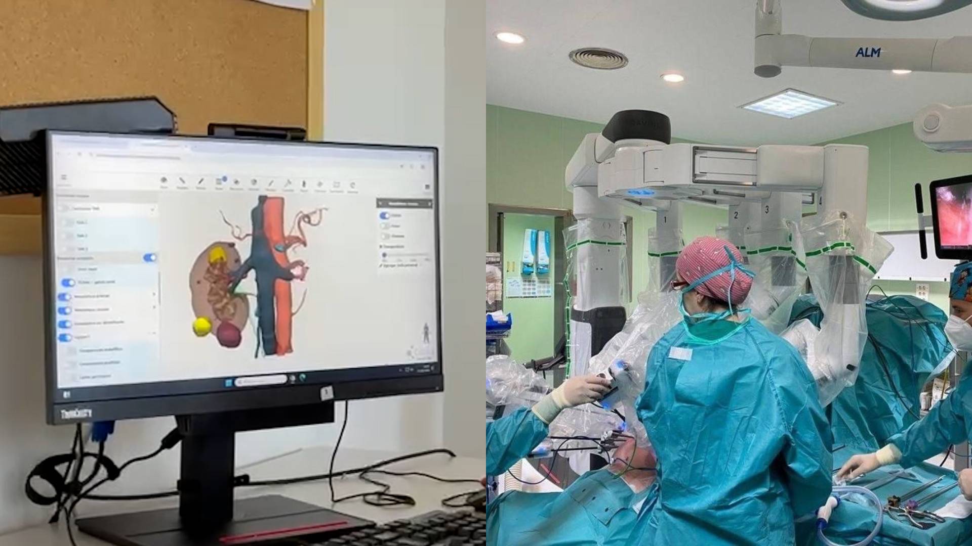 El Clínico de Málaga usa mapas 3D con IA para operar tumores renales con precisión